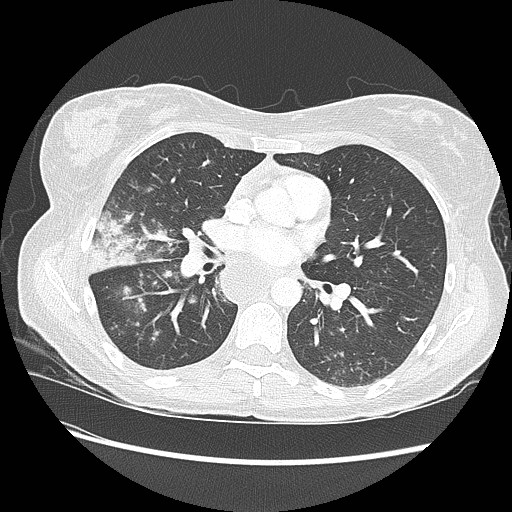 Aspiration pneumonia secondary to laparoscopic banding (Radiopaedia 18345-18183 lung window 55).jpg