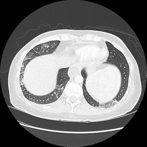 Aspiration pneumonia secondary to laparoscopic banding (Radiopaedia 18345-18183 lung window 91).jpg
