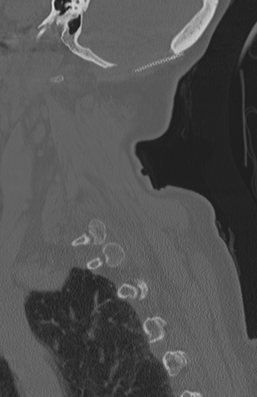 Atlanto-axial subluxation (Radiopaedia 36610-38176 Sagittal bone window 64).png