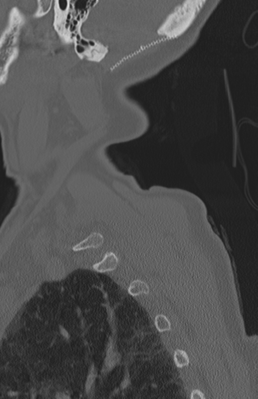 Atlanto-axial subluxation (Radiopaedia 36610-38176 Sagittal bone window 70).png
