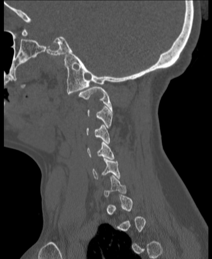 Atlanto-occipital assimilation with basilar invagination (Radiopaedia 70122-80188 Sagittal bone window 5).jpg
