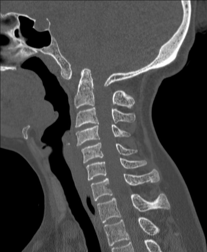 Atlanto-occipital assimilation with basilar invagination (Radiopaedia 70122-80188 Sagittal bone window 63).jpg
