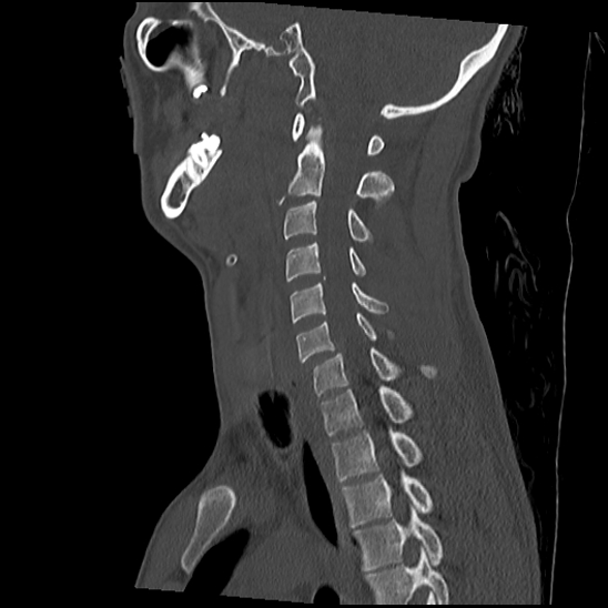 File:Atlanto-occipital dissociation (Traynelis type 1), C2 teardrop fracture, C6-7 facet joint dislocation (Radiopaedia 87655-104061 Sagittal bone window 39).jpg