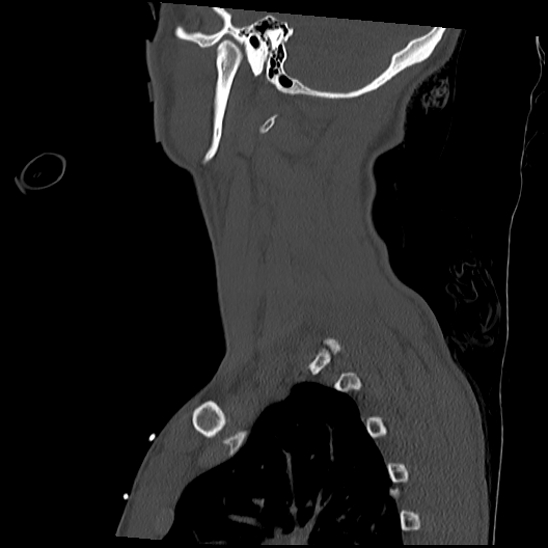 File:Atlanto-occipital dissociation (Traynelis type 1), C2 teardrop fracture, C6-7 facet joint dislocation (Radiopaedia 87655-104061 Sagittal bone window 56).jpg