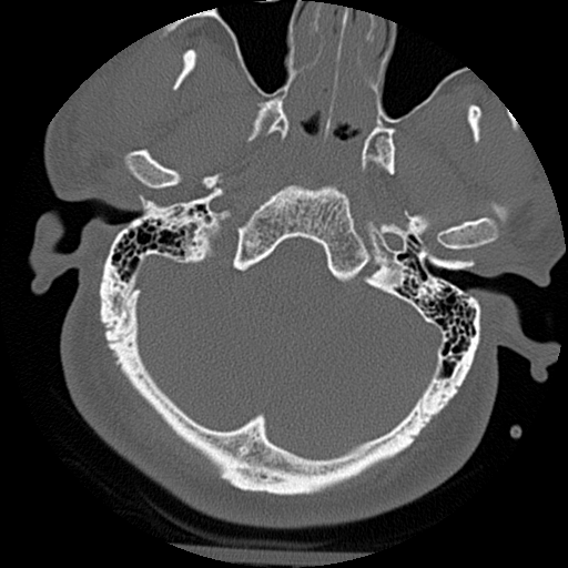 Atlanto-occipital dissociation injury (Radiopaedia 29274-29698 Axial bone window 1).png
