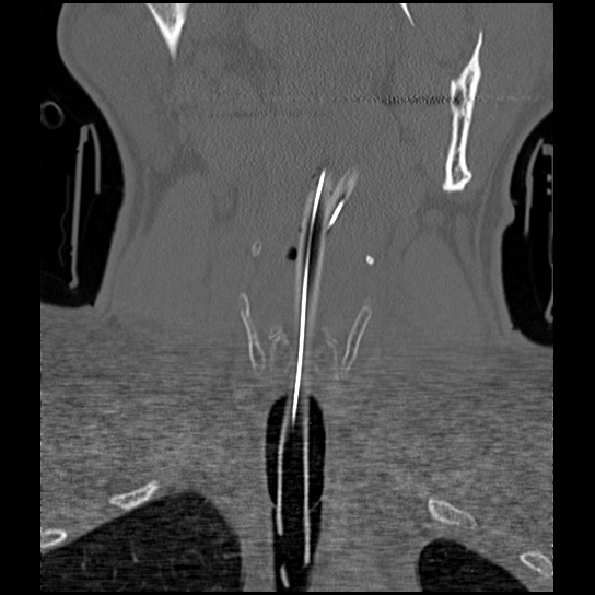 Atlanto-occipital dissociation injury (Radiopaedia 29274-29698 Coronal bone window 40).png