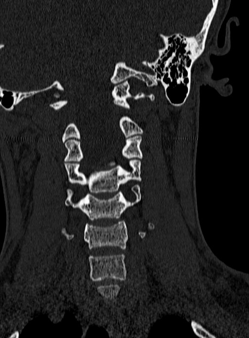 Atlantoaxial subluxation (Radiopaedia 44681-48450 Coronal bone window 65).jpg