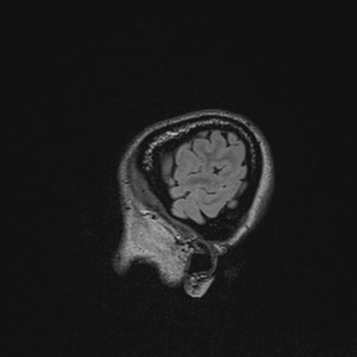 Atretic encephalocoele with inferior vermis hypoplasia (Radiopaedia 30443-31108 Sagittal FLAIR 23).jpg
