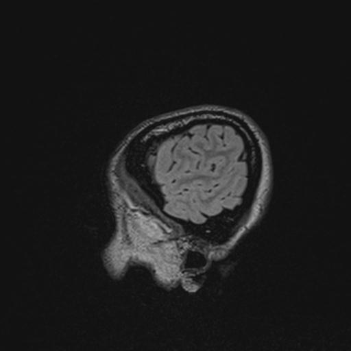 Atretic encephalocoele with inferior vermis hypoplasia (Radiopaedia 30443-31108 Sagittal FLAIR 25).jpg