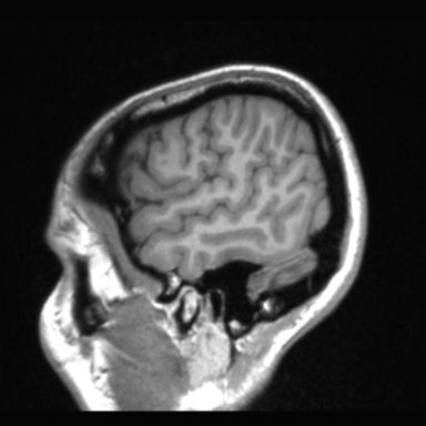 Atretic encephalocoele with inferior vermis hypoplasia (Radiopaedia 30443-31108 Sagittal T1 116).jpg