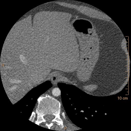 Atrial septal defect (upper sinus venosus type) with partial anomalous pulmonary venous return into superior vena cava (Radiopaedia 73228-83961 A 281).jpg