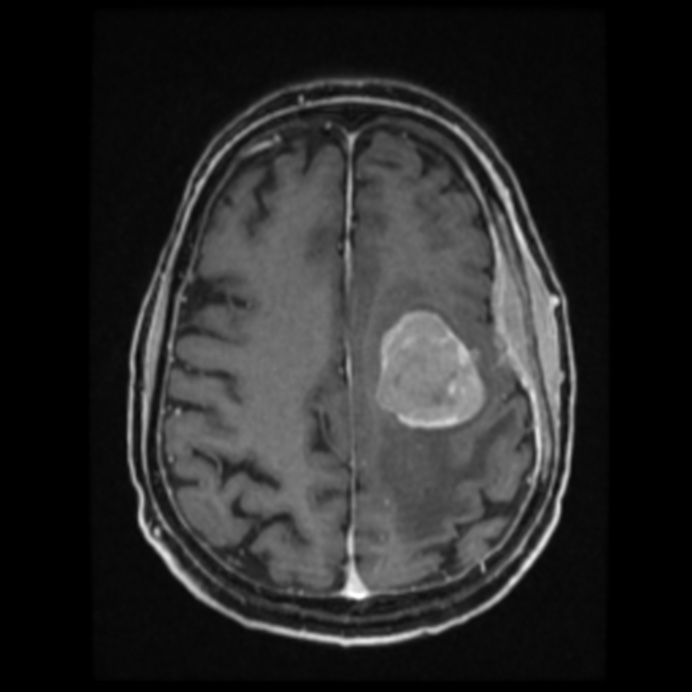 Atypical meningioma (Radiopaedia 45535-49629 Axial T1 C+ 49).jpg