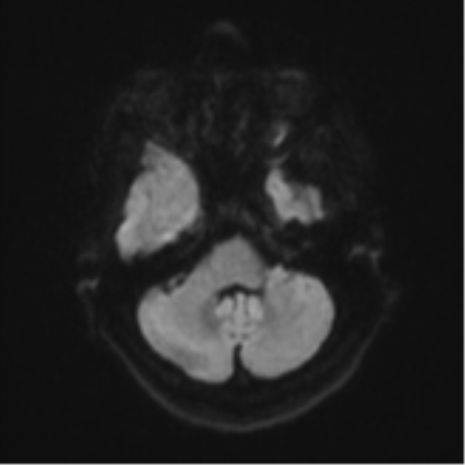 Atypical meningioma (WHO Grade II) (Radiopaedia 54742-60979 Axial DWI 35).png