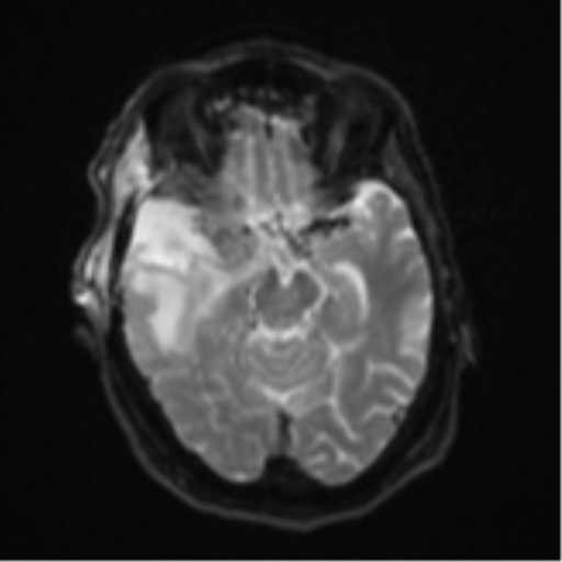 Atypical meningioma (WHO Grade II) (Radiopaedia 54742-60981 Axial DWI 11).png