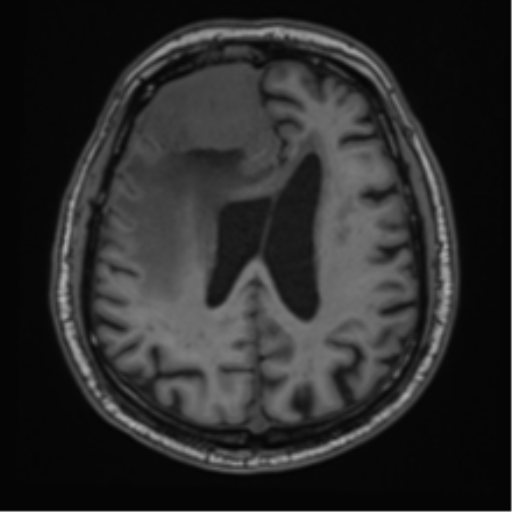 File:Atypical meningioma (WHO grade II) with brain invasion (Radiopaedia 57767-64729 Axial T1 33).png