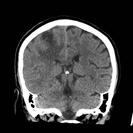 Atypical meningioma (WHO grade II) with osseous invasion (Radiopaedia 53654-59715 Coronal non-contrast 41).png