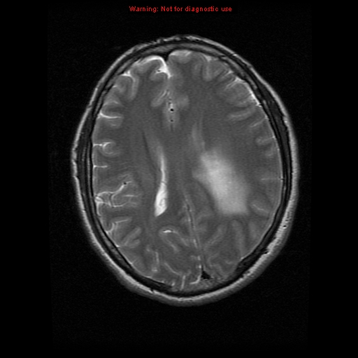 File:Atypical meningioma - grade II (Radiopaedia 13303-13305 Axial T2 14).jpg