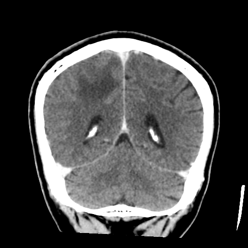 Atypical meningioma with skull invasion (Radiopaedia 34357-35649 Coronal C+ delayed 44).png