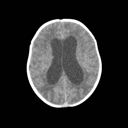 File:Atypical teratoid rhabdoid tumor (prenatal US and neonatal MRI) (Radiopaedia 59091-66387 Axial non-contrast 26).jpg