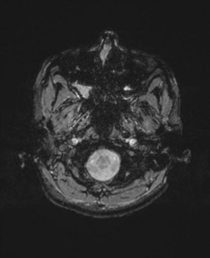 Autoimmune limbic encephalitis (Radiopaedia 30363-31005 SWI - magnitude 6).jpg