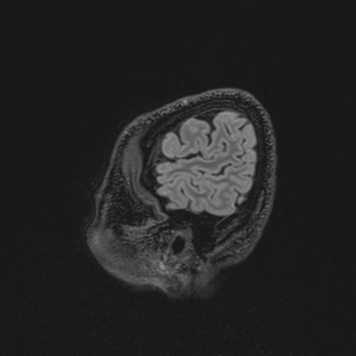 File:Autoimmune limbic encephalitis (Radiopaedia 30363-31005 Sagittal FLAIR 137).jpg