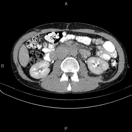 File:Autoimmune pancreatitis (Radiopaedia 84925-100431 Axial C+ delayed 38).jpg