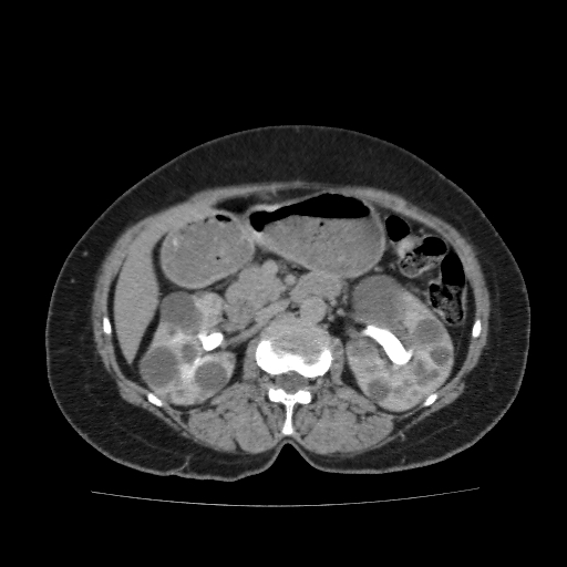 Autosomal dominant polycystic kidney disease (Radiopaedia 38189-40194 Axial C+ delayed 19).jpg
