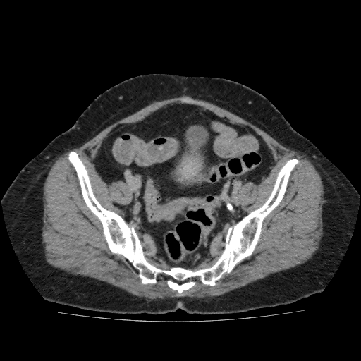 Autosomal dominant polycystic kidney disease (Radiopaedia 38189-40194 Axial C+ delayed 47).jpg