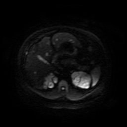 File:Autosomal dominant polycystic kidney disease (Radiopaedia 50259-55611 Axial DWI 52).jpg