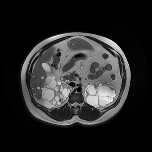 File:Autosomal dominant polycystic kidney disease (Radiopaedia 50259-55611 Axial T2 19).jpg