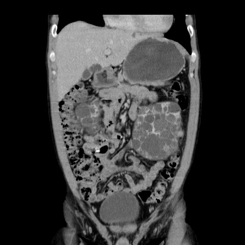 Autosomal dominant polycystic kidney disease (Radiopaedia 66349-75582 A 18).jpg