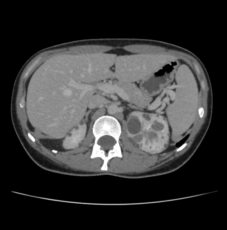 Autosomal dominant polycystic kidney disease - early onset (Radiopaedia 40734-43387 A 16).jpg