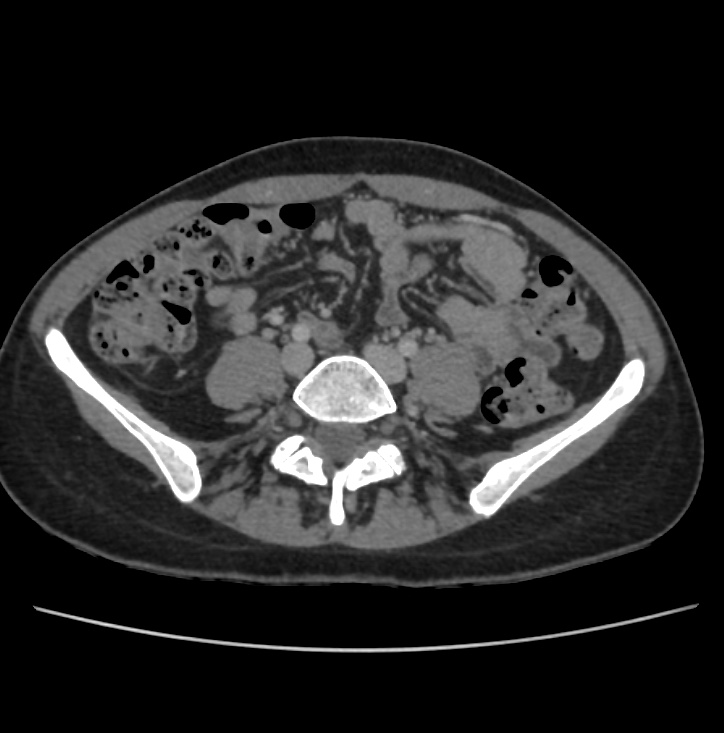 Autosomal dominant polycystic kidney disease - early onset (Radiopaedia 40734-43387 A 57).jpg