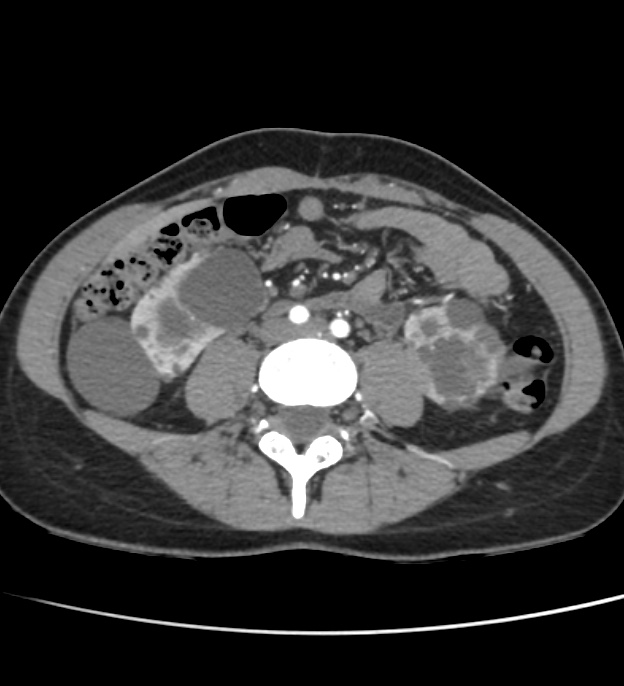 Autosomal dominant polycystic kidney disease - early onset (Radiopaedia 40734-43387 B 46).jpg