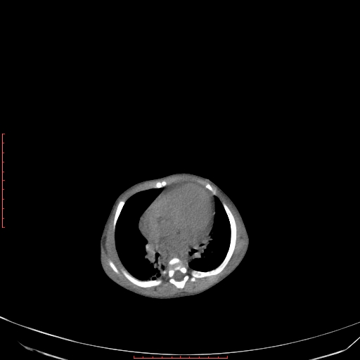 Autosomal recessive polycystic kidney disease associated with Caroli disease (Radiopaedia 61932-69984 B 62).jpg