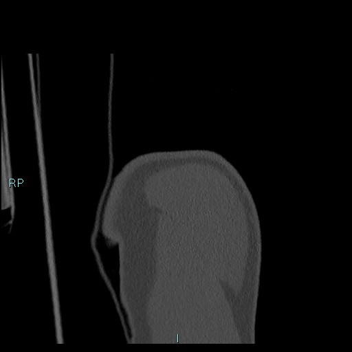 Avascular necrosis after fracture dislocations of the proximal humerus (Radiopaedia 88078-104655 Coronal bone window 23).jpg