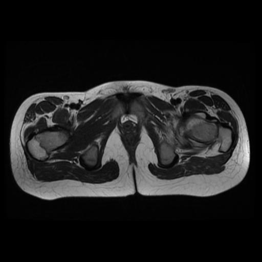 File:Avascular necrosis of the hip (Radiopaedia 29563-30067 Axial T2 13).jpg