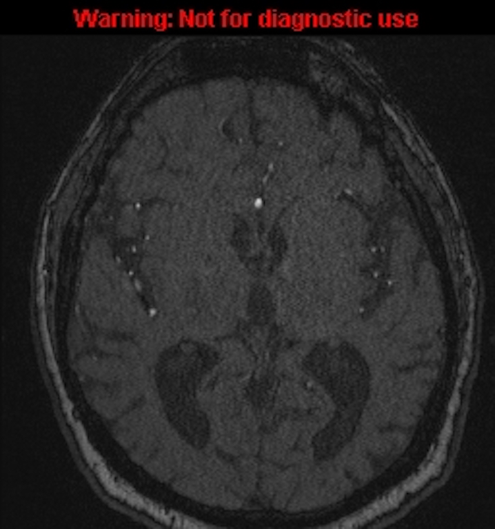 Azygos anterior cerebral artery (Radiopaedia 59325-66677 Axial MRA 88).jpg