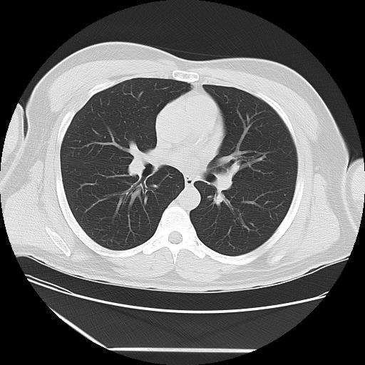 Azygos fissure (Radiopaedia 88181-104784 Axial lung window 24).jpg