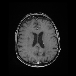 File:Balo concentric sclerosis (Radiopaedia 53875-59982 Axial LAVA C+ 167).jpg