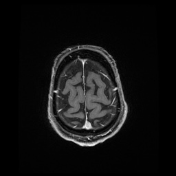 Balo concentric sclerosis (Radiopaedia 53875-59982 Axial LAVA C+ 231).jpg