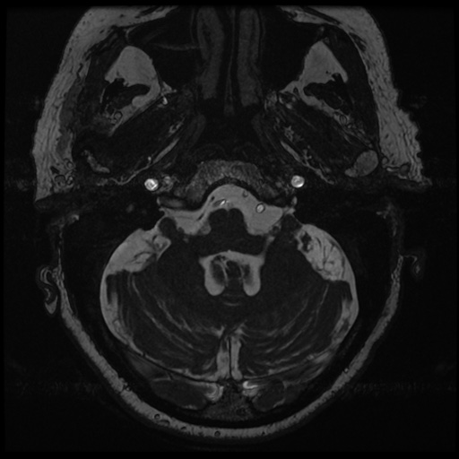 File:Balo concentric sclerosis (Radiopaedia 53875-59982 Axial T2 FIESTA 19).jpg