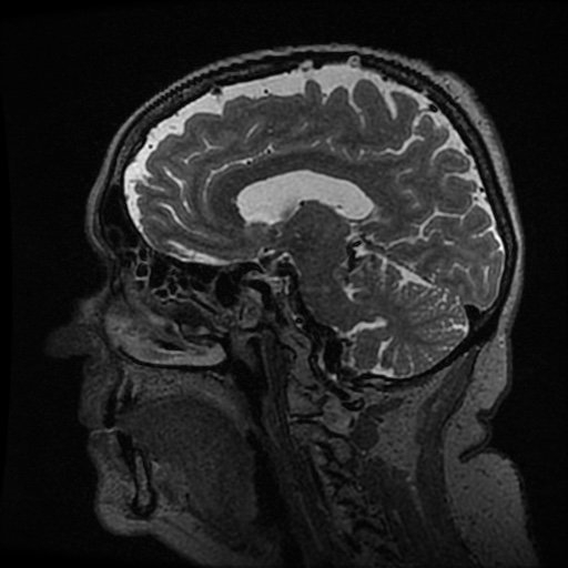 Balo concentric sclerosis (Radiopaedia 53875-59982 Sagittal 3D FSE 123).jpg