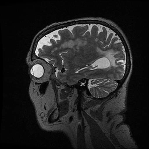 Balo concentric sclerosis (Radiopaedia 53875-59982 Sagittal 3D FSE 74).jpg