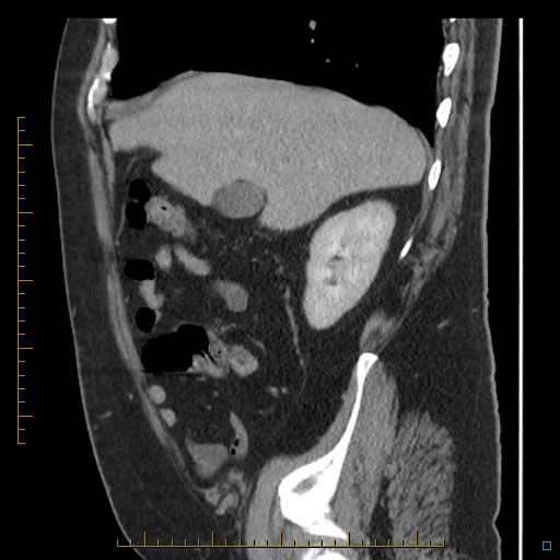Bariatric balloon causing gastric outlet obstruction (Radiopaedia 54449-60672 C 61).jpg
