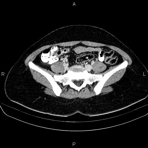 File:Bartholin gland cyst (Radiopaedia 62635-70930 Axial Post contrast 16).jpg