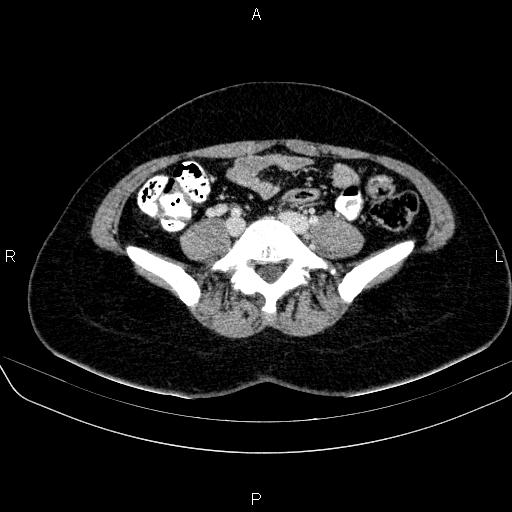 File:Bartholin gland cyst (Radiopaedia 62635-70930 Axial Post contrast 6).jpg