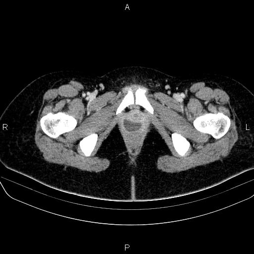 File:Bartholin gland cyst (Radiopaedia 62635-70930 Axial Post contrast 84).jpg