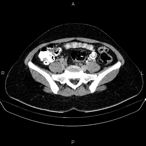 Bartholin gland cyst (Radiopaedia 62635-70930 C 16).jpg