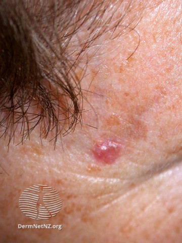 Basal cell carcinoma affecting the face (DermNet NZ lesions-bcc-face-0923).jpg